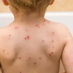 Jak bezpiecznie kąpać dziecko z ospą, aby złagodzić objawy i swędzenie